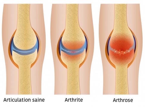 arthrose vs arthrite